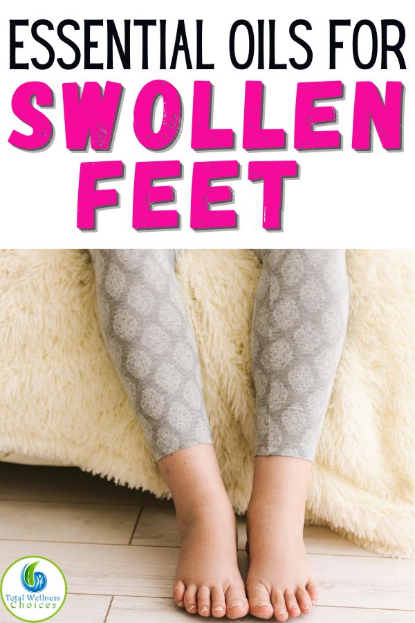 If you are looking for swollen feet remedies or how to get rid of edema in the feet and ankles, then you may find these essential oils for swollen feet and ankles helpful for reducing foot and leg edema or water retention. #edema #swollenankles #swollenfeetremedies #essentialoils #naturalremedies Swollen Feet Remedies, Feet Remedies, Essential Oils Guide, Swollen Legs, Reduce Swelling, Essential Oils Herbs, Essential Oils Health, Yl Essential Oils, Young Living Oils