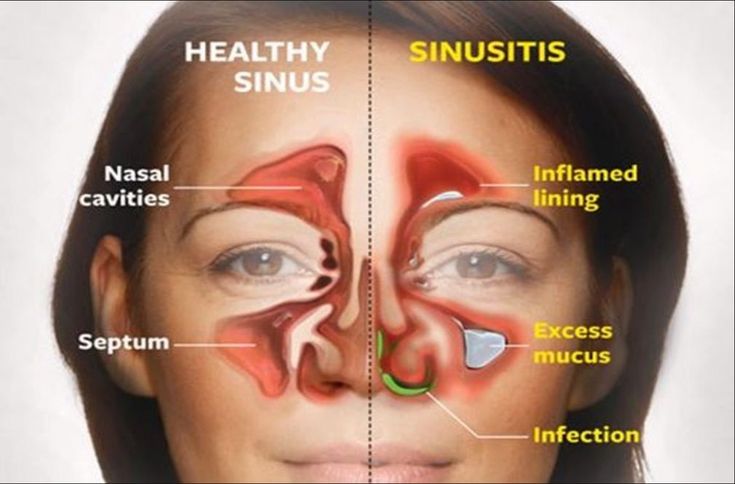 Kill Sinus Infection in 20 Seconds with This Simple Method and This Common Household Ingredient! Remedy For Sinus Congestion, Sinus Remedies, Home Remedies For Sinus, Sinus Infection Remedies, Allergy Remedies, Sinus Infection, Diy Health, Vitamin D3, Natural Home Remedies