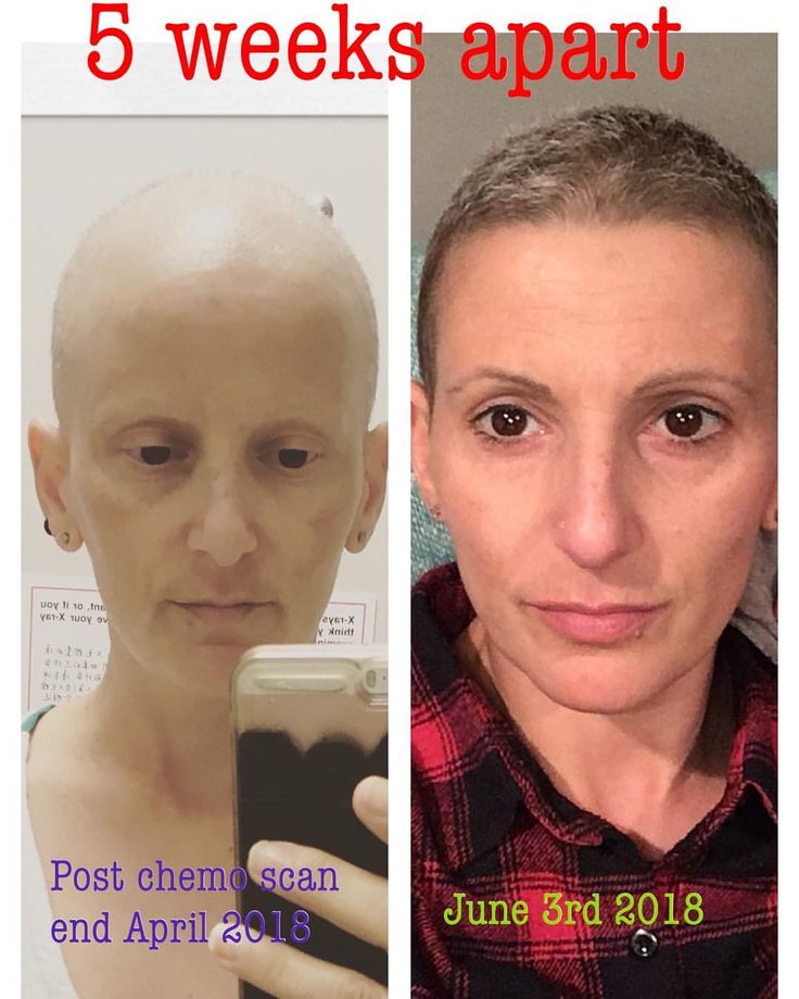 Hair growth after chemotherapy Hair growth after chemo, Hair mask