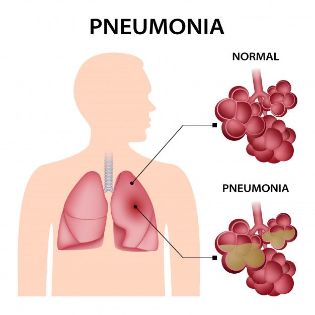 Conceito de pneumonia | Vetor Premium | Tratamento pneumonia, Remédios ...