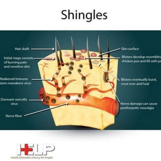 #shingles #anatomy #shinglesrelief #shinglesremedy #shinglesinfo #shinglesvaccine #abcshingles Treating Shingles, Shingles Relief, Nursing Skills, Nursing Quotes, Nursing Information, Autoimmune Disorders, Nerve Fiber, Nursing Notes, Nurse Quotes