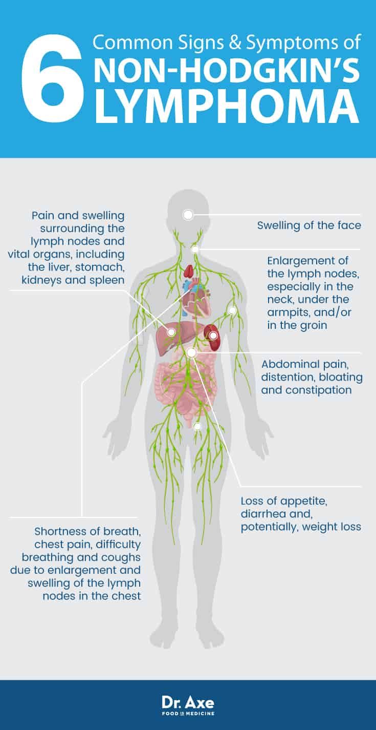 Non-Hodgkin's Lymphoma: Natural Symptom Management - Dr. Axe Follicular Lymphoma, Non Hodgkins, Lymph Nodes, Leg Pain, Medical Insurance, Medical Technology, Abdominal Pain, Signs And Symptoms, Nursing School