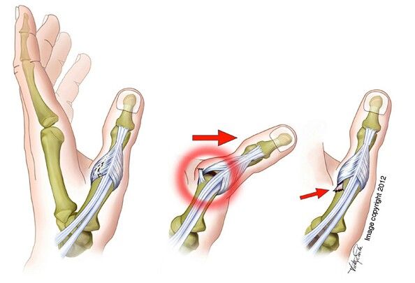 ulnar collateral ligament of the thumb tear Human Spine, Hand Therapy, Occupational Therapy, Nerve, Plastic Surgery, Surgery, Anatomy, Medical, Google Search