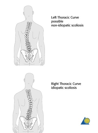 Usually in idiopathic scoliosis the curve pattern is such that there is a right thoracic curve. If there is a left thoracic curve, this might be an ... Exercises For Lower Back, Back Brace, Lower Back Exercises, Trigger Points, Lower Back, Helpful Tips, Bending, Back Pain, Surgery