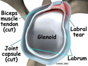 Labral tear, shoulder surgery. Labral Tear Shoulder, Rotator Cuff Rehab ...