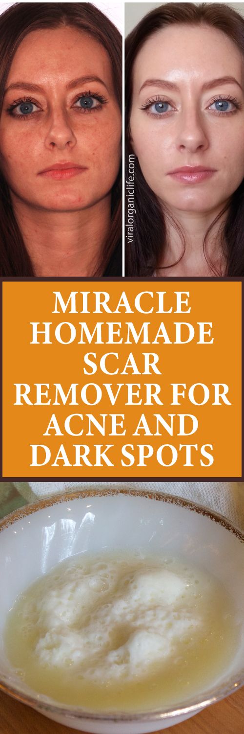 Miracle Homemade Scar Remover For Acne and Dark Spots Mascara Tricks, Acne Home Remedies, Remedies For Acne, Applying Mascara, Apply Mascara, Scar Removal Cream, Scar Remover, Skin Care Routine For 20s, Blackheads Removal