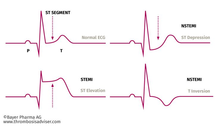 Stemi Vs Nstemi Nursing, Stemi Nstemi, Paramedic Cardiology, Stemi Ekg, Stemi Vs Nstemi, Telemetry Technician, Er Nursing, Nursing Hacks, Bsc Nursing