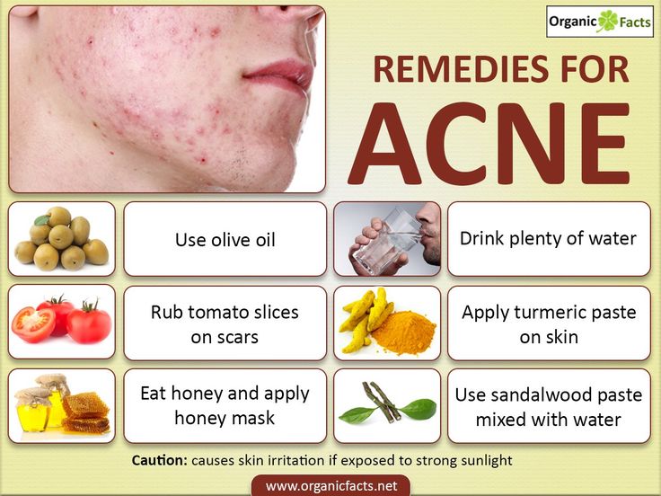 Home remedies for acne scars include sandalwood, ice, tomato, cucumber, eggs, turmeric, Aloe Vera, apple cider vinegar, lime juice, honey, water, lavender oil, fenugreek and fruits and vegetables. Home remedies for acne scars are useful in cases of severe infection or when acne has been squeezed. Mild acne scars heal on their own, while the deep scars might remain for entire life. Mild acne scars can be safely and effectively treated with home remedies using natural products. Severe Acne Remedies, Clear Skin Remedies, Acne Scar Diy, Remedies For Acne, Mild Acne, Coconut Oil For Acne, Pimples Remedies, Honey Water, Tomato Cucumber