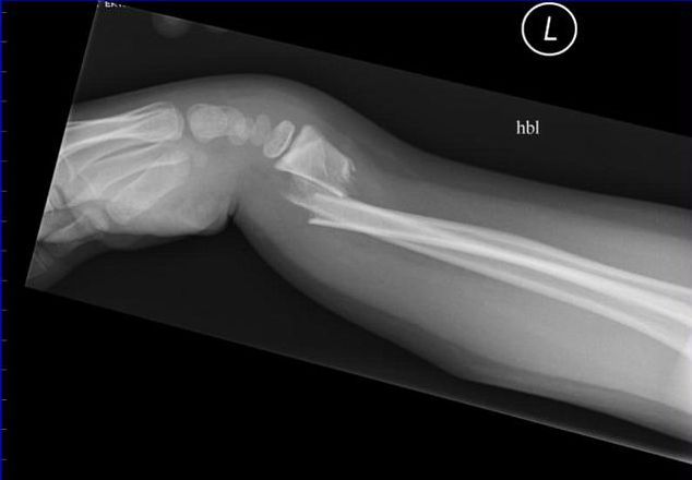 Colles’ Fracture The colles’ fracture is the most common pathology involving the wrist. It is caused by falling onto an outstretched hand. Colles Fracture, Outstretched Hand, Anatomy Images, Orthopedic Surgery, Hand Therapy, Med School, Medical Students, Radiology, The Hand