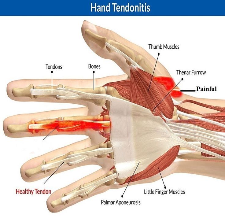 Get rid of De Quervain's Syndrome ? Gamekeeper's Thumb, and carpometacarpal instabilities, the premium wrist and thumb splints are Ideal in treating De Quervain's Syndrome #DeQuervainsSyndrome #Thumbpain #Wristpain #Pain #Medical #MDUB #clinic #painsolution #Gamekeeper #UTAH #USA #Unitedstates #Fitness #Health #Thumb #Hand #doctor #Getridofpain Thumb Splint, Essential Oil Remedy, Wrist Brace, Human Body Anatomy, Oil Remedies, Hand Pain, Hand Therapy, Body Anatomy, Tea Tree Essential Oil