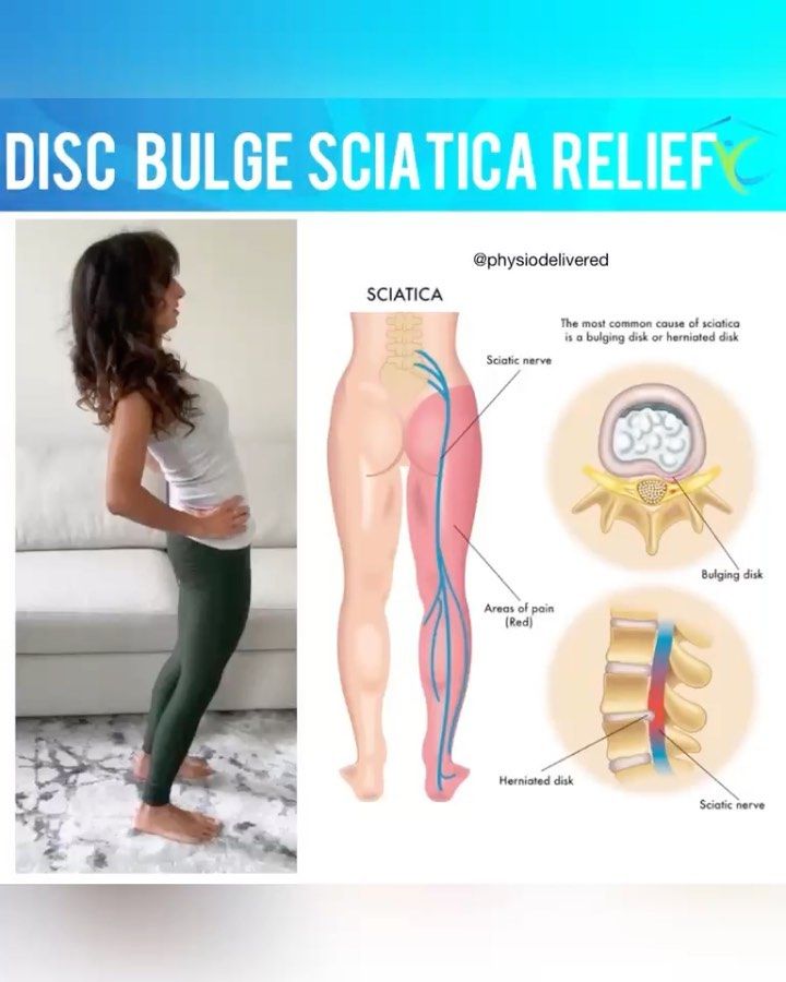 Physiotherapy Delivered on Instagram: “✨EXTENSION EXERCISES are the safest and most effective for a posteriorly bulging or herniated disc. This is because it creates pressure…” Bulging Disc Relief, Bulging Disc Exercises, Disc Exercises, Extension Exercises, Medical Massage, Bulging Disc, Sciatica Relief, Office Exercise, Lower Back Exercises