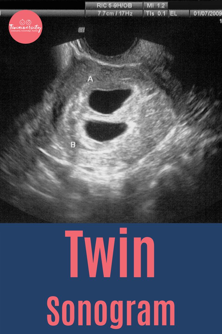 Did You Find Out It Was Twins At A Later Ultrasound? | Sonogram, 7 ...