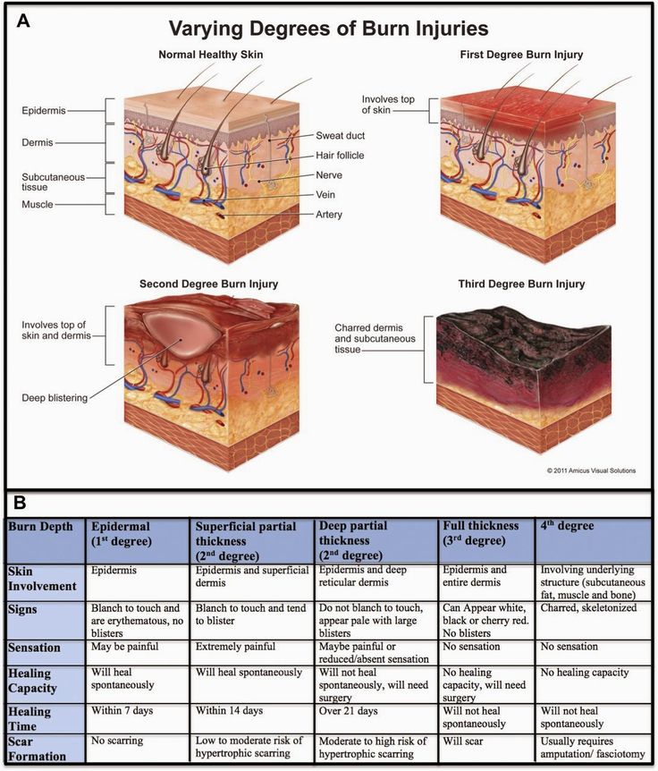 Skin Burn Temperature Chart