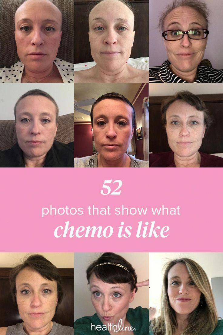 My Chemotherapy Diary 52 Photos of Hair Loss and Recovery 