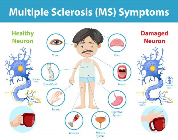 multiple sclerois ms symptoms in the body and on the chest, with different types of neurons