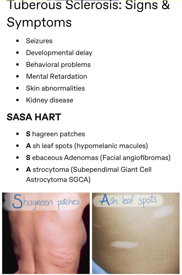 Tuberous sclerosis Tuberous Sclerosis, Ash Leaf, Developmental Delays, Human Anatomy And Physiology, Neurology, Anatomy And Physiology, Signs And Symptoms, Human Anatomy, Dermatology