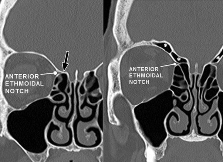 Supraorbital Air Cells - They are pneumatized orbital plate of the frontal bone, originating from  anterior ethmoid air cells extending posteriorly and superiorly over the orbit from the frontal recess. They may mimic septated frontal sinuses - (a) When the ethmoidal notch abuts the fovea ethmoidalis (arrow) or lateral lamella, it is considered protected. (b) With supraorbital pneumatization (*), the anterior ethmoidal artery is at risk for injury during FESS Frontal Bone, Indian Family, Stomach Problems, Self Care Activities, Quick Saves