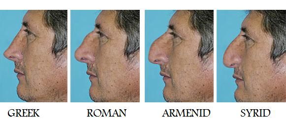 before and after photos of a man's nose surgery