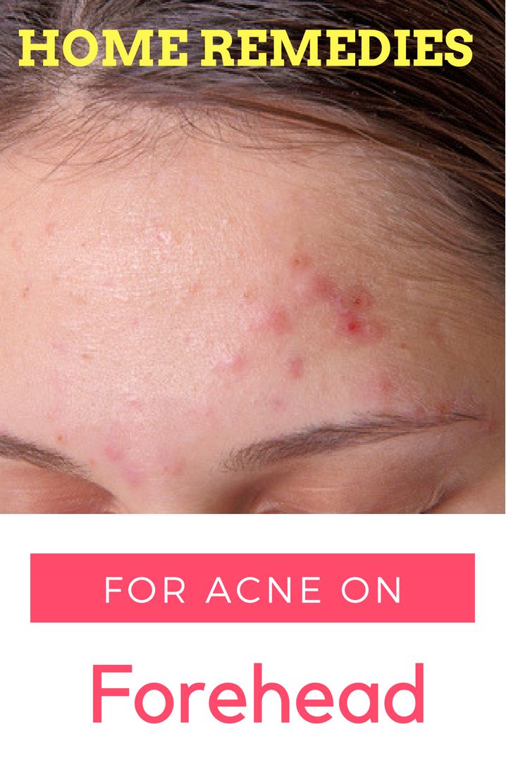 Get acne frequently on your forehead, try these home remedies Witch Hazel Acne, Pimples On Forehead, Garnier Skin Care, Remedies For Acne, Baby Acne, Skin Care Routine For 20s, Oily Skin Care Routine, Home Remedies For Acne, Acne Remedies