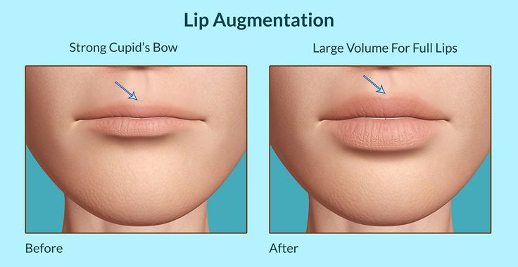 Lip Augmentation                                                                                                                                                                                 More Lips Surgery, Diy Lip Plumper, Juvederm Lips, Derma Fillers, Fuller Lips Naturally, Lip Surgery, Plumper Lips, Lip Types, Fuller Lips