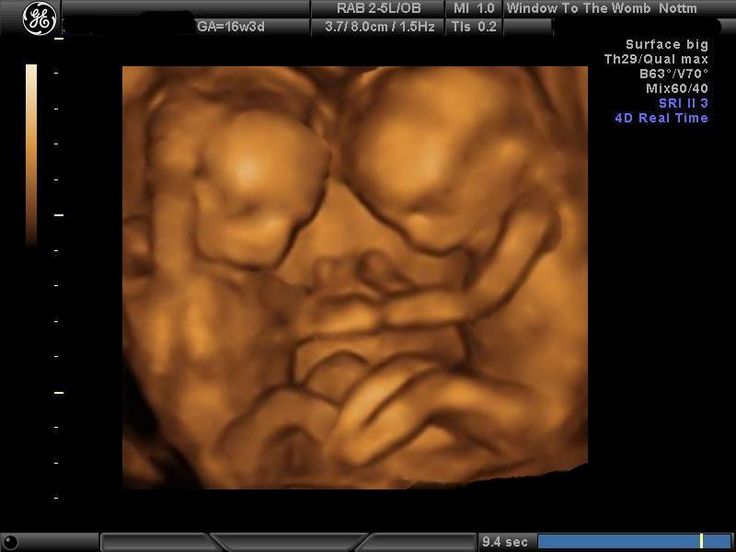 Tiny 16 week 3d ultrasound images. | Twins ultrasound, Twins, Baby ...