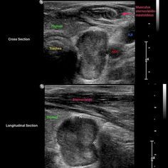 parathyroid adenoma/hyperplasia in a patient on chronic hemodialysis Ultrasound Sonography, Radiology, Ultrasound, On Instagram, Instagram