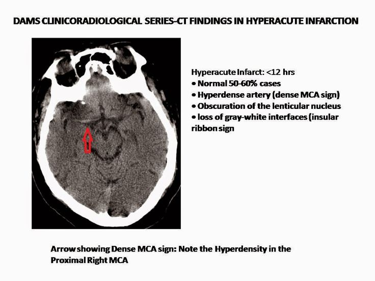 Sumer's Radiology Blog: Dense MCA sign-Hyperacute Infarction Arrow Show, Radiology, Blogging, Signs