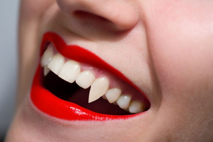 fake vampire teeth that look real | ... something like 'teeth smile' or 'open teeth smile' and found an image Aesthetic Hombre, Gum Surgery, Black Teeth, Teeth Straightening, Charcoal Powder, Dental Veneers, Vampire Teeth, Dental Cosmetics, Smile Makeover