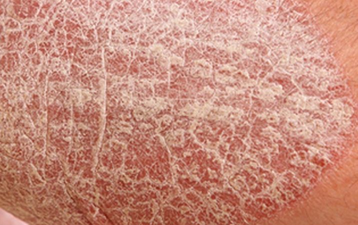 Nobody wants irritable, itchy, dry and flaky skin on their body. The article provides some detailed information on scaly skin, dry skin, dry peeling skin, dry crack skin associated with flaky skin that usually appears … Dry Peeling Skin, Systemic Inflammation, Scaly Skin, Skin To Skin, Cracked Skin, Skin Disorders, Peeling Skin, Flaky Skin, Natural Treatments