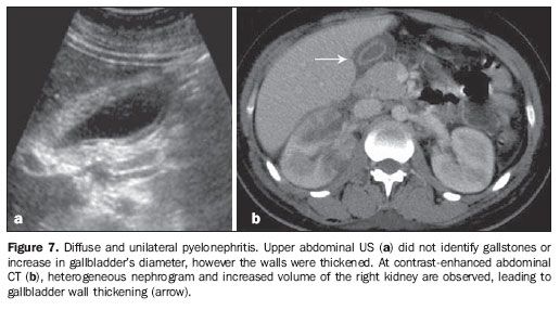 Acalculous cholecystitis is frequently misdiagnosed, as some sonographers equivocally attribute to chronic acalculous cholecystitis, the secondary thickening determined by systemic pathologies such as pyelonephritis(16), for example. Another common erroneous interpretation occurs in cases of acute cholecystitis caused by non-visualized small obstructive calculi in the common bile duct Bile Duct, Calculus, Ultrasound, The Common