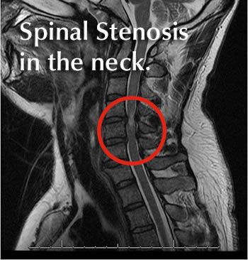 cervical spinal stenosis Stenosis Of The Spine, Stenosis Exercises, Radiology Imaging, Cervical Spondylosis, Spinal Decompression, Neck Surgery, Spinal Nerve, Spine Health, Spine Surgery