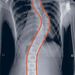 treatscoliosis