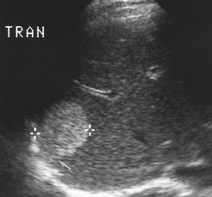 Hepatic Hemangioma Ultrasound