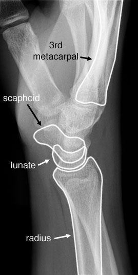 Radiographic Anatomy of the Skeleton: Wrist -- Lateral View, Unidad ...