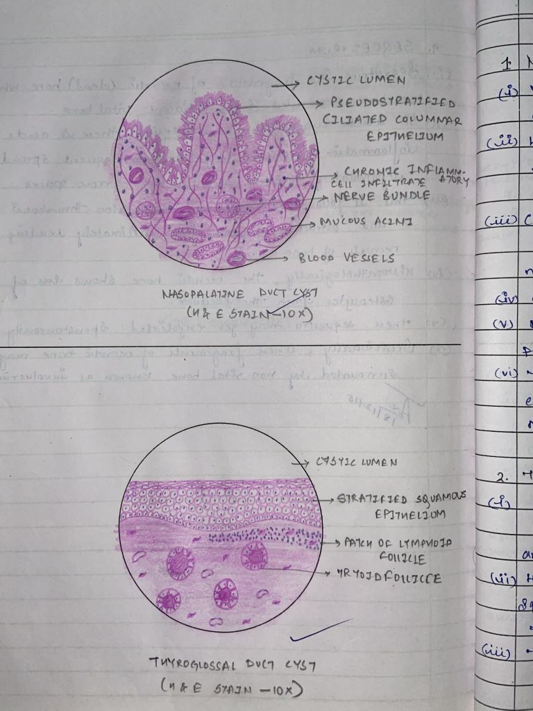 DIAGRAMS CYSTS OF NON-ODONTOGENIC TUMOR – Dentowesome | Oral pathology ...