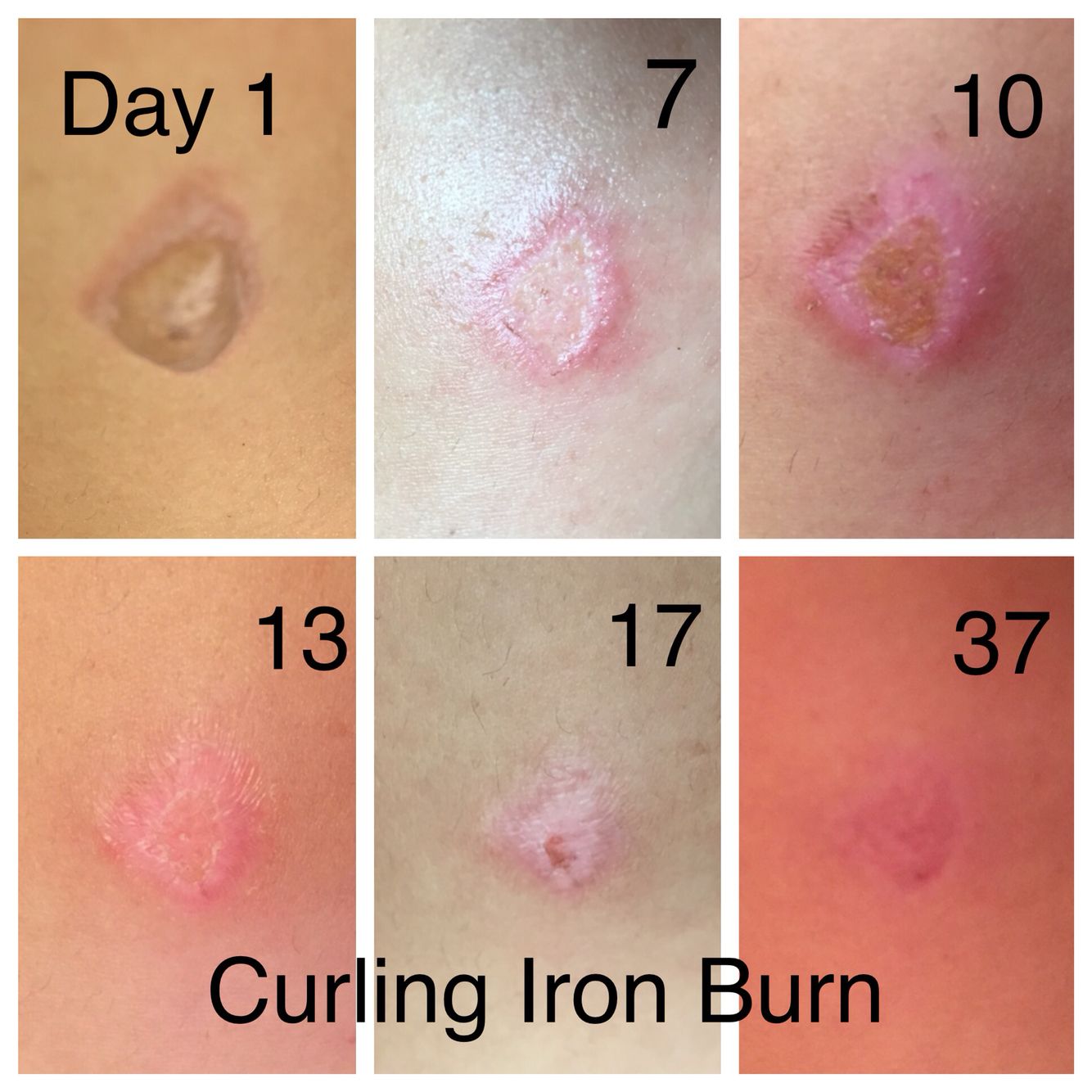 2nd Degree Burn Healed