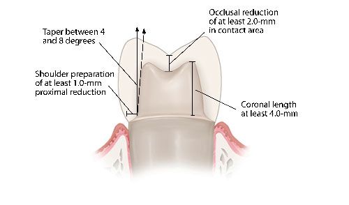 Image result for molar PFM crown prep