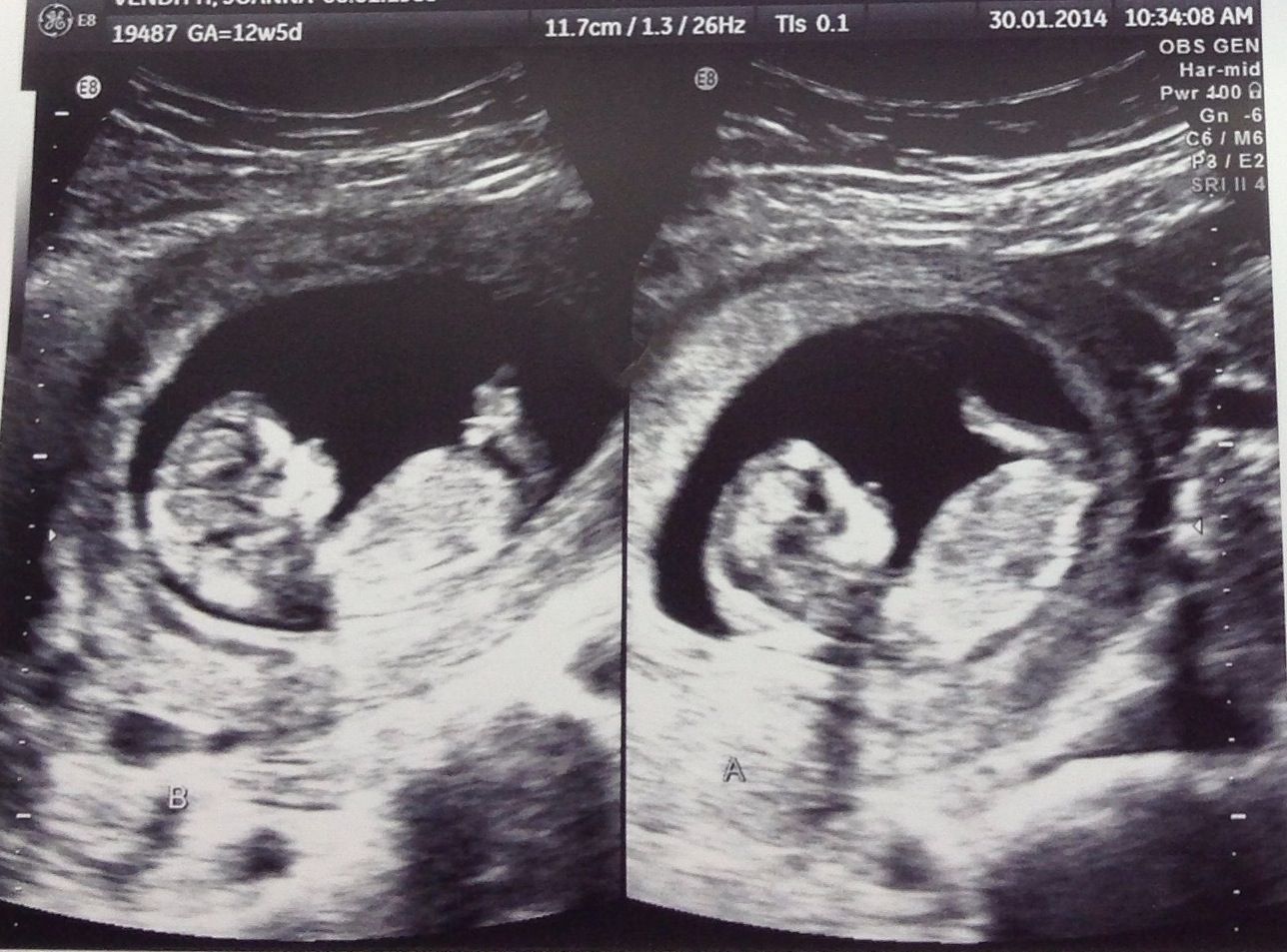 hair on ultrasound 30 weeks - Sina Barger