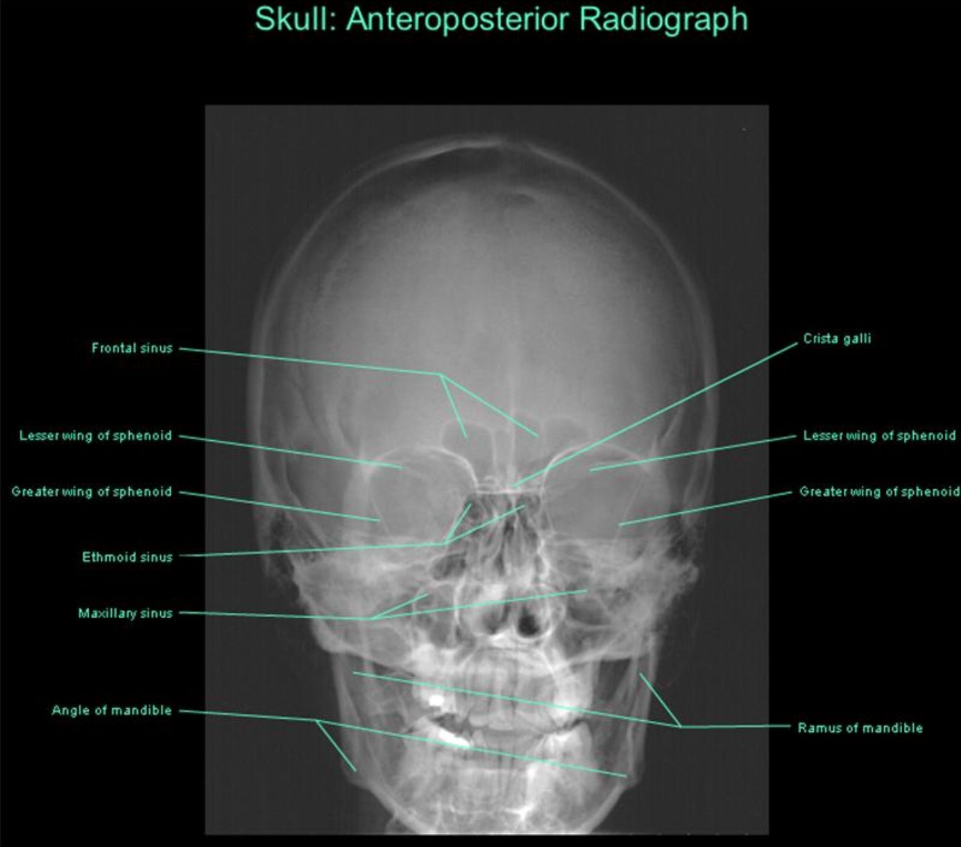 Greater Wing Of Sphenoid Radiograph