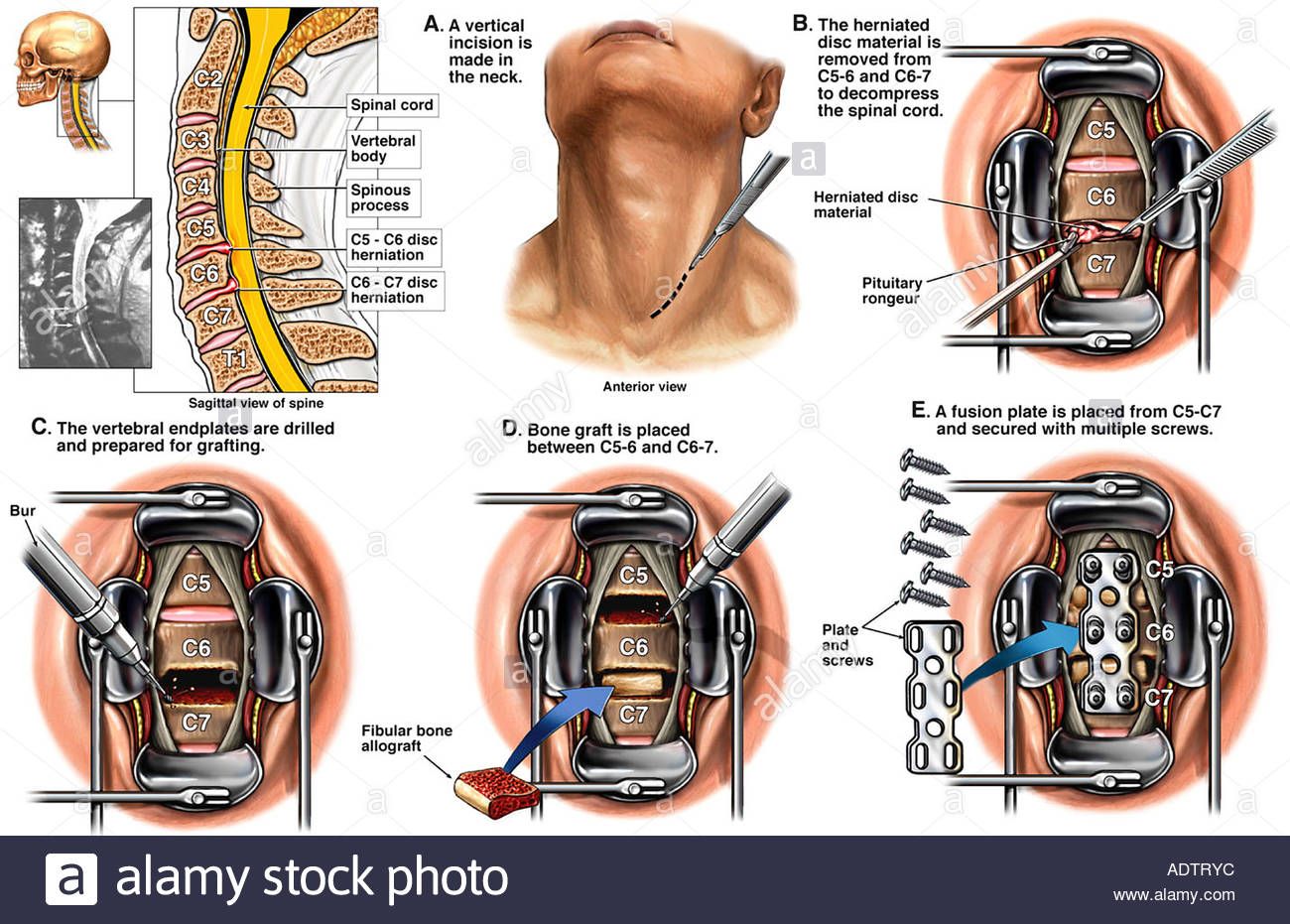 Acdf anterior cervical discectomy and fusion – Artofit