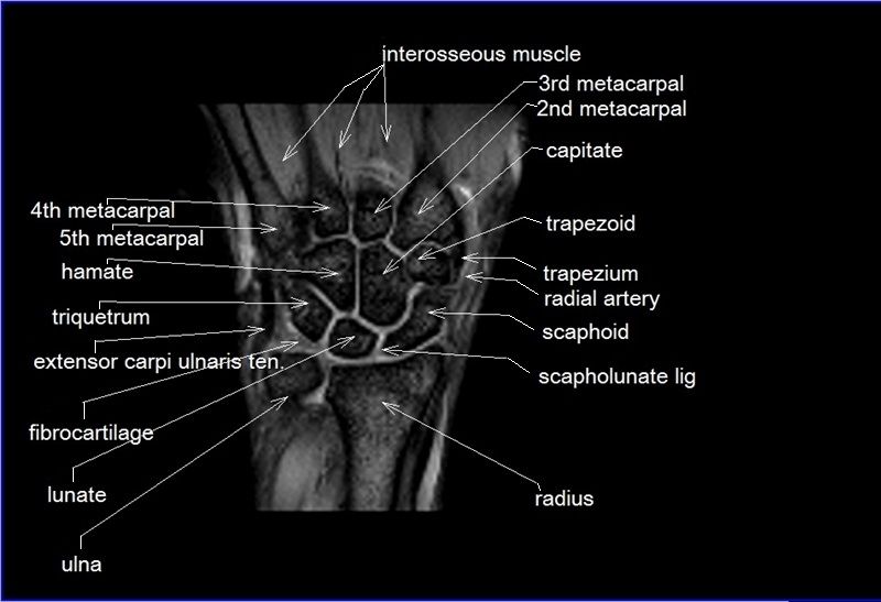 Anatomy And Imaging Of Wrist Joint Mri And Xray Ppt - vrogue.co