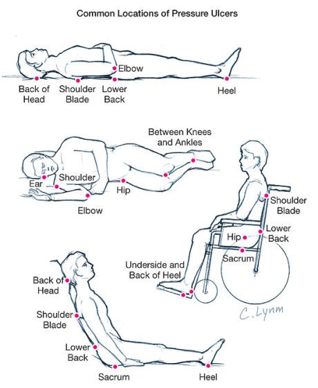 Pressure Ulcer Care Team Diagram