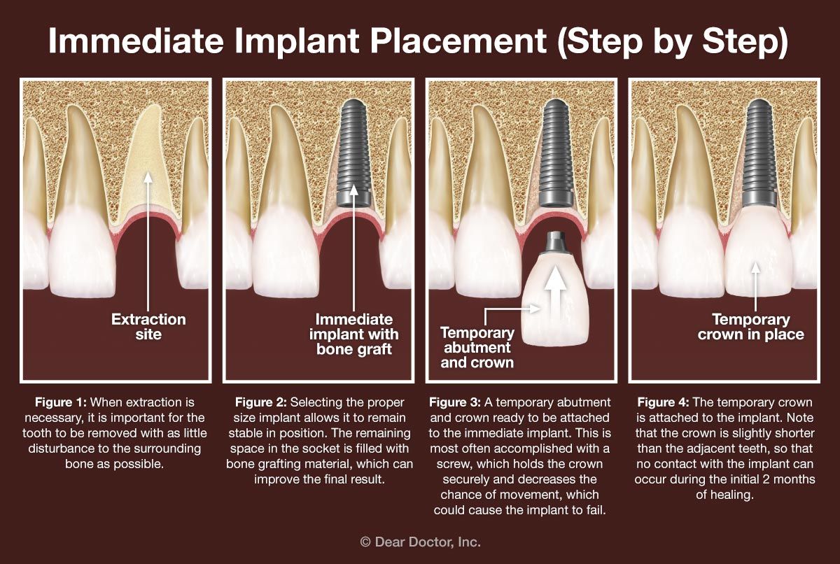 Immediate dental implant placement - step by step. | Dental, Dental ...