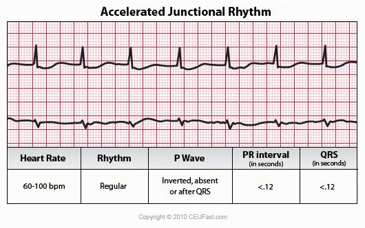 EKG, ECG Interpretation