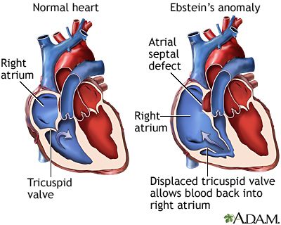 Ebstein's anomaly. | Ebstein's anomaly, Congenital heart disease, Anomaly