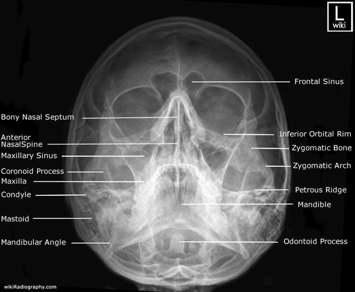 Waters view of maxillary sinus | Radiologi, Kedokteran, Medis