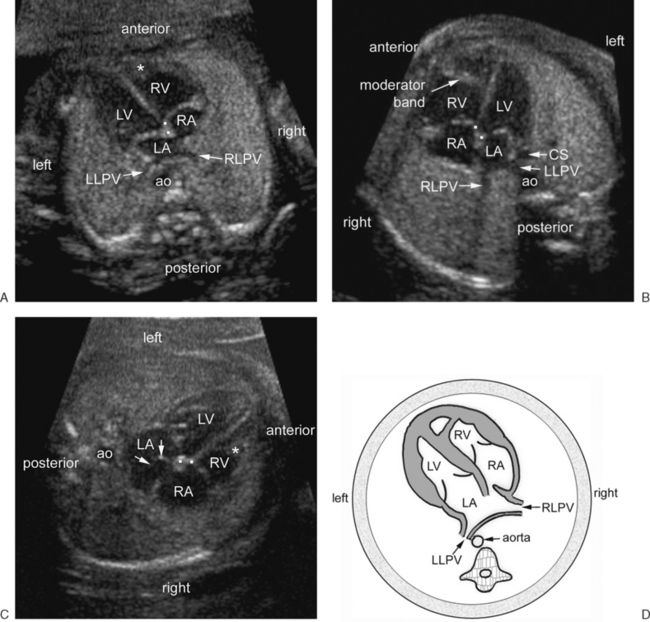 Fetal Heart Ultrasound How To Obstetric Ultrasound Ul - vrogue.co