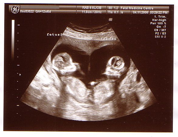 Twins - 12 Week Scan (Heart shaped) | Cute baby twins, Baby ultrasound ...