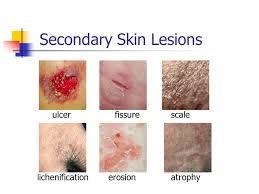 Pin by Lesli De on Secondary lesions | Keloid, Skin disorders, Ulcers