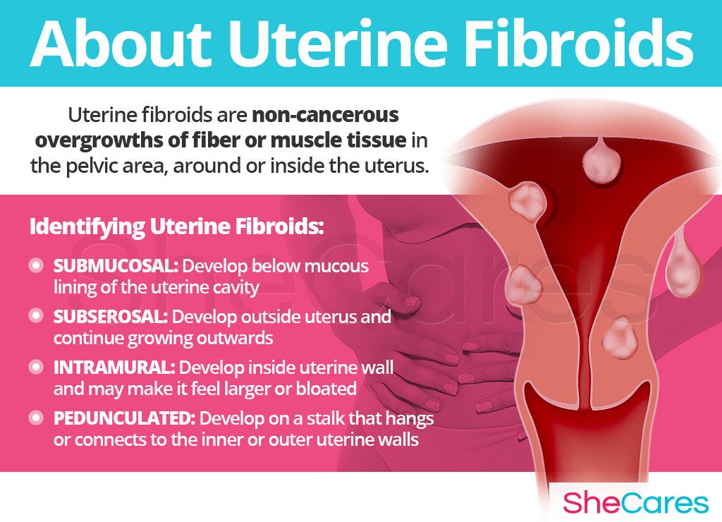 Uterine Fibroid Size Chart